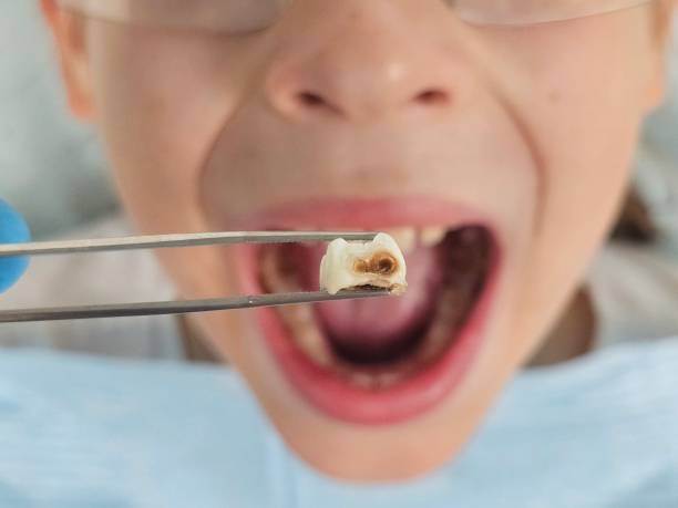 Best Emergency Tooth Extraction in East Dundee, IL