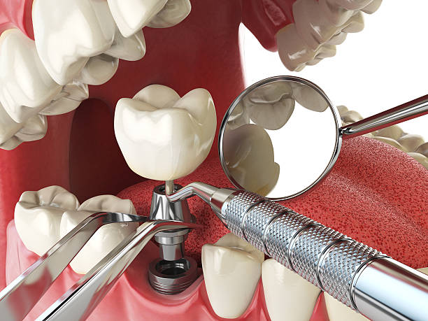 Best Emergency Dental Care for Broken or Chipped Teeth in East Dundee, IL